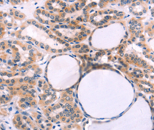 Immunohistochemistry of paraffin-embedded Human thyroid cancer using ST2 Polyclonal Antibody at dilution of 1:40