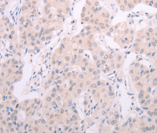 Immunohistochemistry of paraffin-embedded Human lung cancer tissue using TSHR Polyclonal Antibody at dilution 1:50