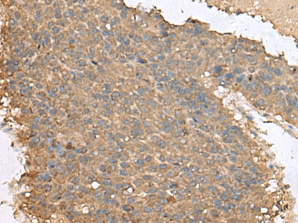 Immunohistochemistry of paraffin-embedded Human liver cancer tissue  using FAM19A4 Polyclonal Antibody at dilution of 1:65(?200)