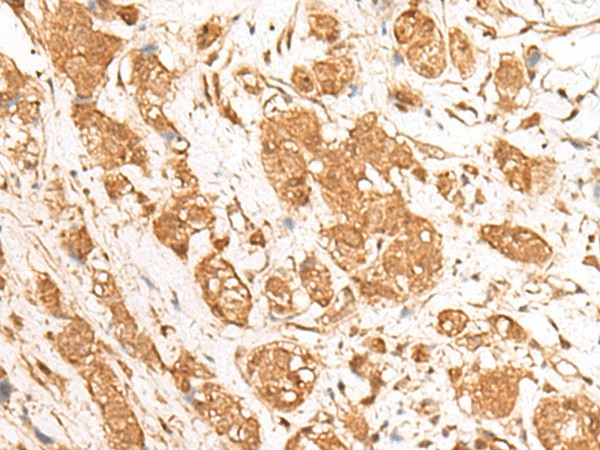 Immunohistochemistry of paraffin-embedded Human breast cancer tissue  using GANC Polyclonal Antibody at dilution of 1:55(?200)