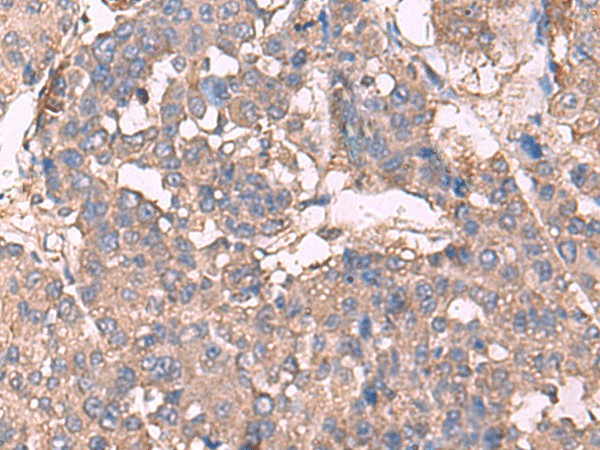 Immunohistochemistry of paraffin-embedded Human liver cancer tissue  using KCNN2 Polyclonal Antibody at dilution of 1:30(?200)