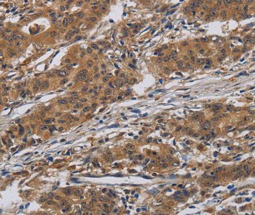 Immunohistochemistry of paraffin-embedded Human gasrtic cancer tissue using INPPL1 Polyclonal Antibody at dilution 1:40