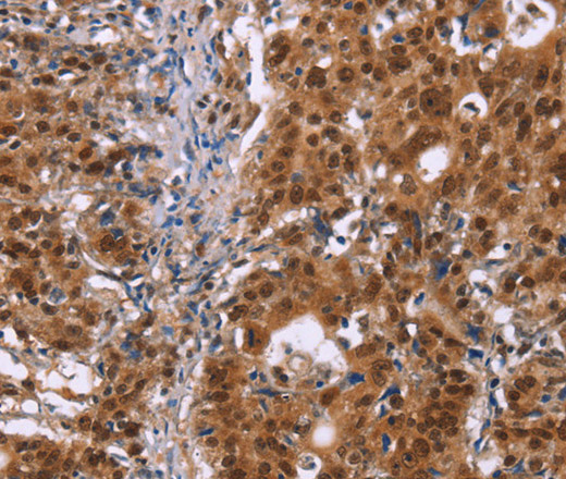 Immunohistochemistry of paraffin-embedded Human gastic cancer using CBX3 Polyclonal Antibody at dilution of 1:40