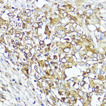 Immunohistochemistry of paraffin-embedded Human liver cancer using MLKL Polyclonal Antibody at dilution of  1:200 (40x lens).