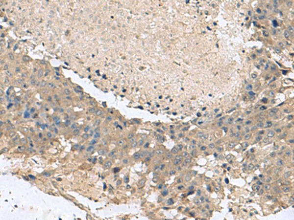 Immunohistochemistry of paraffin-embedded Human liver cancer tissue  using KCTD7 Polyclonal Antibody at dilution of 1:55(?200)