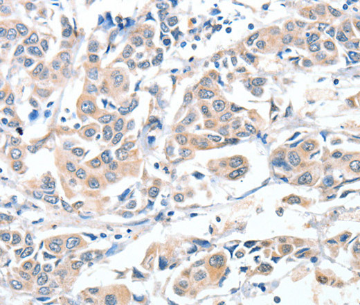 Immunohistochemistry of paraffin-embedded Human breast cancer using CD156c Polyclonal Antibody at dilution of 1:30
