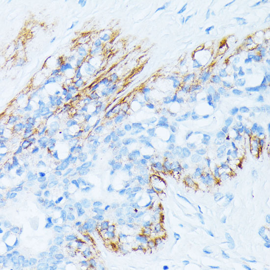 Immunohistochemistry of paraffin-embedded Human breast cancer using TPM2 Polyclonal Antibody at dilution of 1:100 (40x lens).