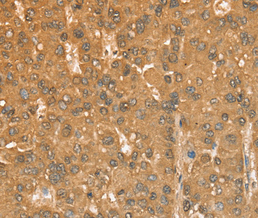 Immunohistochemistry of paraffin-embedded Human liver cancer tissue using CXCR4 Polyclonal Antibody at dilution 1:50