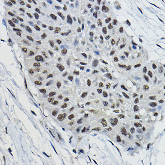 Immunohistochemistry of paraffin-embedded human lung cancer using BRAP Polyclonal Antibody at dilution of 1:100 (40x lens).Perform high pressure antigen retrieval with 10 mM citrate buffer pH 6.0 before commencing with IHC staining protocol.