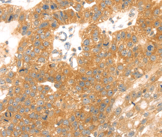 Immunohistochemistry of paraffin-embedded Human breast cancer tissue using TMEFF2 Polyclonal Antibody at dilution 1:35