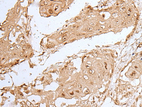 Immunohistochemistry of paraffin-embedded Human esophagus cancer tissue  using HOXC9 Polyclonal Antibody at dilution of 1:35(?200)