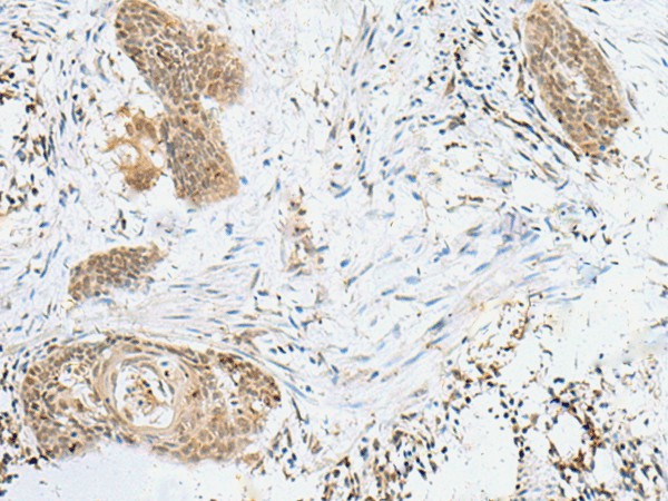 Immunohistochemistry of paraffin-embedded Human esophagus cancer tissue  using LPXN Polyclonal Antibody at dilution of 1:60(?200)