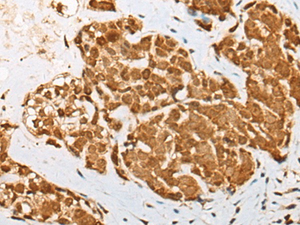 Immunohistochemistry of paraffin-embedded Human thyroid cancer tissue  using ATN1 Polyclonal Antibody at dilution of 1:50(?200)