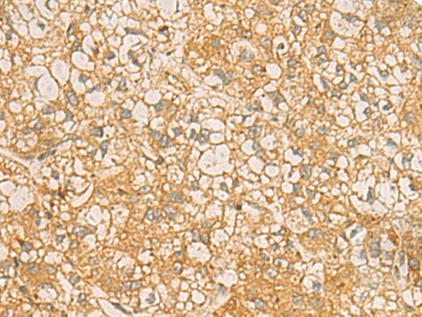 Immunohistochemistry of paraffin-embedded Human liver cancer tissue  using FAAP100 Polyclonal Antibody at dilution of 1:50(?200)