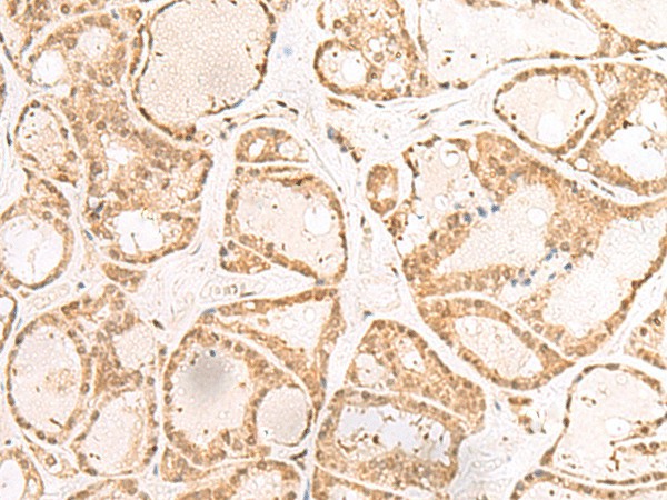 Immunohistochemistry of paraffin-embedded Human thyroid cancer tissue  using RBM19 Polyclonal Antibody at dilution of 1:30(?200)