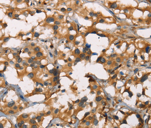 Immunohistochemistry of paraffin-embedded Human thyroid cancer using SENP1 Polyclonal Antibody at dilution of 1:40