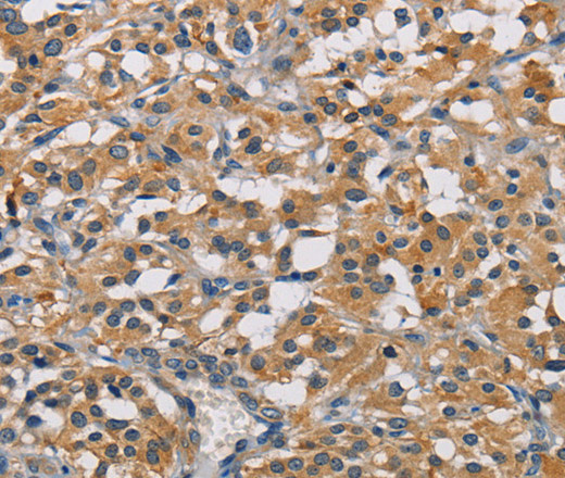 Immunohistochemistry of paraffin-embedded Human thyroid cancer using GPM6A Polyclonal Antibody at dilution of 1:50