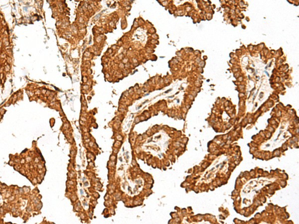 Immunohistochemistry of paraffin-embedded Human thyroid cancer tissue  using GBP4 Polyclonal Antibody at dilution of 1:45(?200)