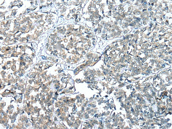 Immunohistochemistry of paraffin-embedded Human esophagus cancer tissue  using COMMD6 Polyclonal Antibody at dilution of 1:45(?200)