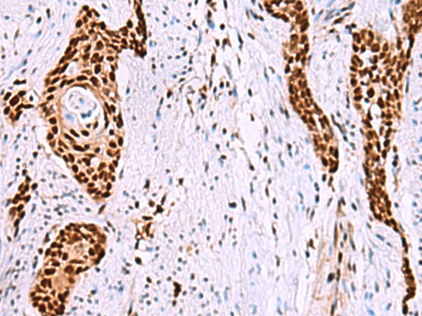 Immunohistochemistry of paraffin-embedded Human esophagus cancer tissue  using ISY1-RAB43 Polyclonal Antibody at dilution of 1:55(?200)