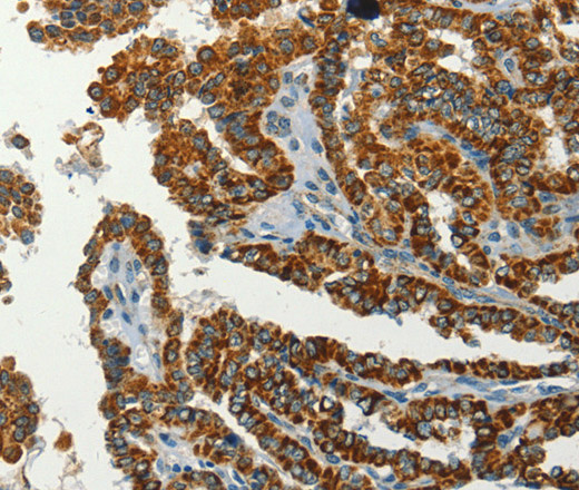 Immunohistochemistry of paraffin-embedded Human thyroid cancer using SERPINA9 Polyclonal Antibody at dilution of 1:60