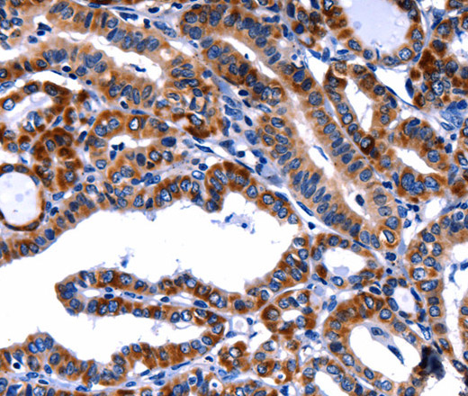 Immunohistochemistry of paraffin-embedded Human thyroid cancer tissue using FBN1 Polyclonal Antibody at dilution 1:40