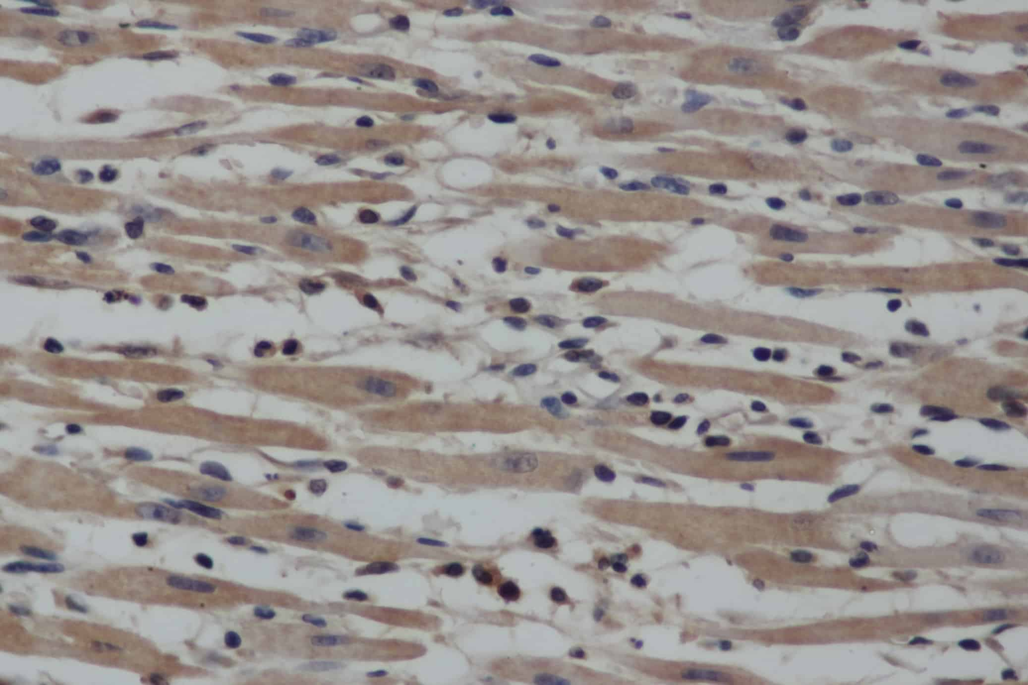 Immunohistochemistry of paraffin-embedded Human gasrtic cancer tissue using NOS2 Polyclonal Antibody at dilution 1:40