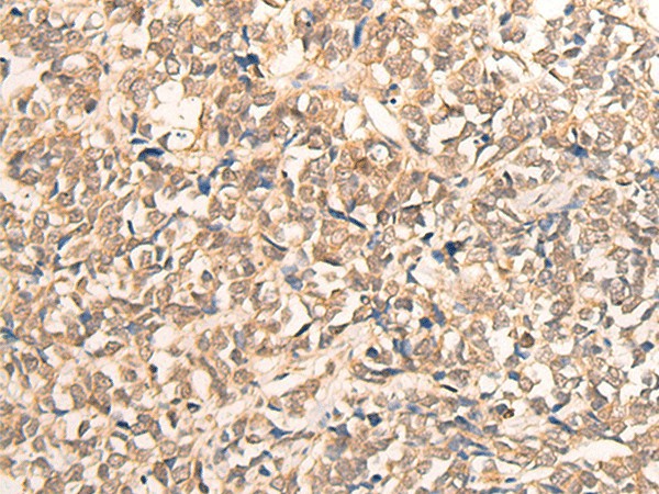 Immunohistochemistry of paraffin-embedded Human lung cancer tissue  using CPS1 Polyclonal Antibody at dilution of 1:35(?200)