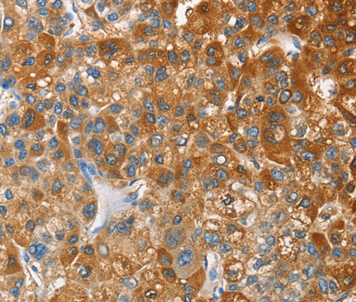 Immunohistochemistry of paraffin-embedded Human liver cancer tissue using OX2R Polyclonal Antibody at dilution 1:60