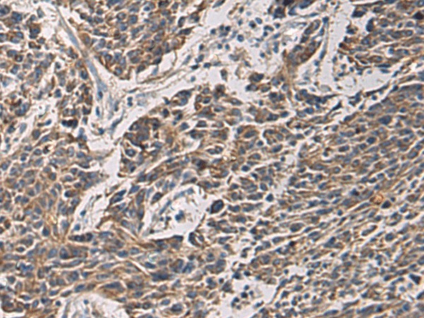 Immunohistochemistry of paraffin-embedded Human colorectal cancer tissue  using MAPKAPK3 Polyclonal Antibody at dilution of 1:95(?200)