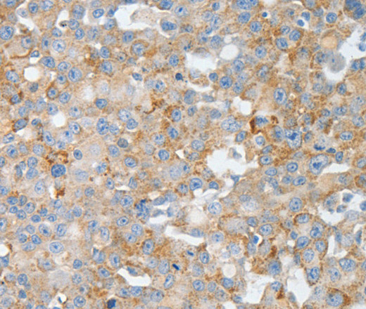 Immunohistochemistry of paraffin-embedded Human breast cancer using BPIFB2 Polyclonal Antibody at dilution of 1:50