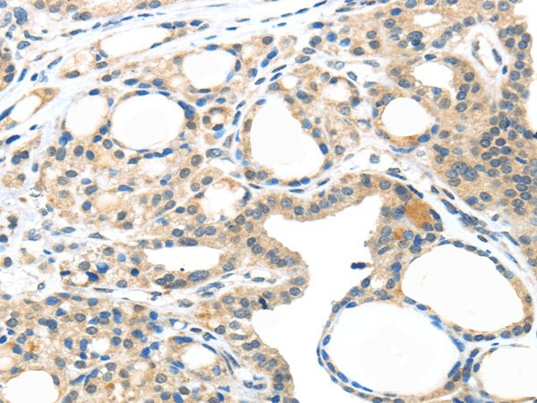 Immunohistochemistry of paraffin-embedded Human thyroid cancer tissue using MASP2 Polyclonal Antibody at dilution 1:35