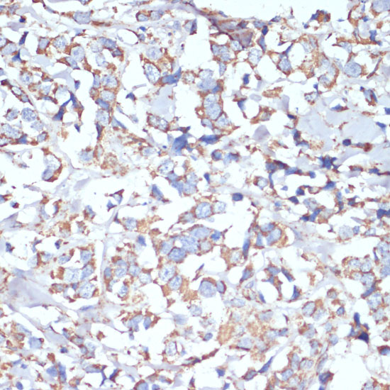 Immunohistochemistry of paraffin-embedded Human breast cancer using COX5A Polyclonal Antibody at dilution of 1:100 (40x lens).