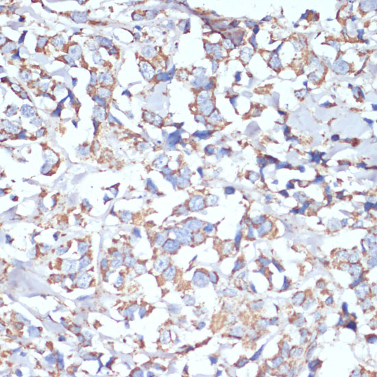 Immunohistochemistry of paraffin-embedded Human breast cancer using COX5A Polyclonal Antibody at dilution of  1:100 (40x lens).