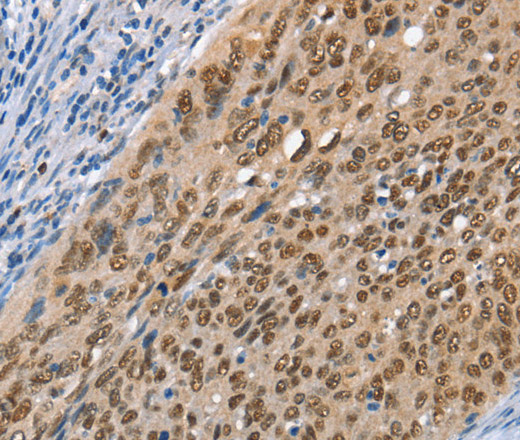 Immunohistochemistry of paraffin-embedded Human cervical cancer using MCM6 Polyclonal Antibody at dilution of 1:45