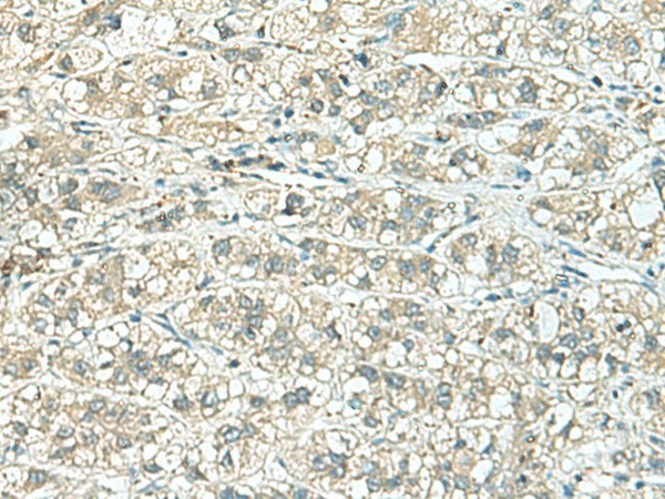 Immunohistochemistry of paraffin-embedded Human liver cancer tissue  using TENT5C Polyclonal Antibody at dilution of 1:110(?200)