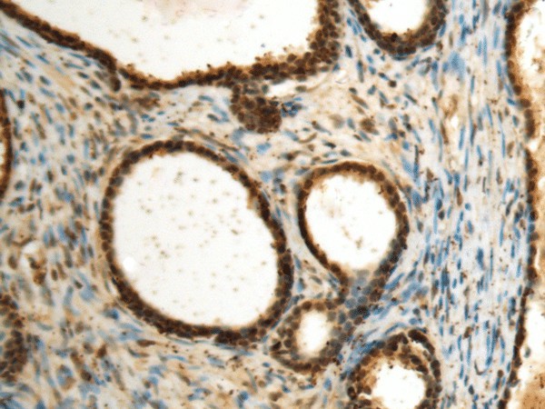 Immunohistochemistry of paraffin-embedded Human prost at e cancer tissue  using SEPHS1 Polyclonal Antibody at dilution of 1:85(?200)