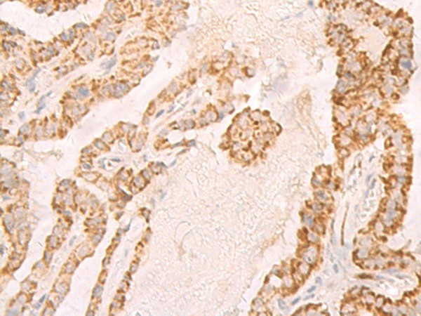 Immunohistochemistry of paraffin-embedded Human thyroid cancer tissue  using IL7R Polyclonal Antibody at dilution of 1:45(?200)