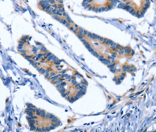 Immunohistochemistry of paraffin-embedded Human colon cancer using IBSP Polyclonal Antibody at dilution of 1:50