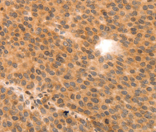 Immunohistochemistry of paraffin-embedded Human liver cancer using MYL9 Polyclonal Antibody at dilution of 1:80