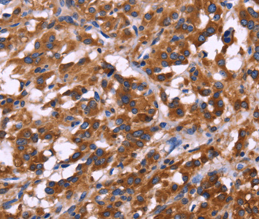 Immunohistochemistry of paraffin-embedded Human thyroid cancer tissue using KIR2DL1/3/4/S4 Polyclonal Antibody at dilution 1:30