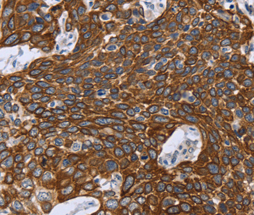 Immunohistochemistry of paraffin-embedded Human cervical cancer using GRPR Polyclonal Antibody at dilution of 1:40