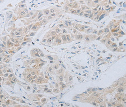 Immunohistochemistry of paraffin-embedded Human lung cancer using LOX Polyclonal Antibody at dilution of 1:30