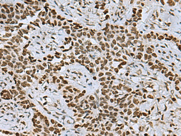 Immunohistochemistry of paraffin-embedded Human ovarian cancer tissue  using MYEF2 Polyclonal Antibody at dilution of 1:55(?200)