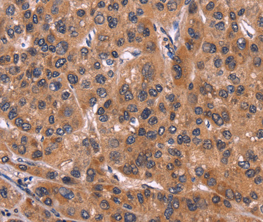 Immunohistochemistry of paraffin-embedded Human liver cancer tissue using ART5 Polyclonal Antibody at dilution 1:50