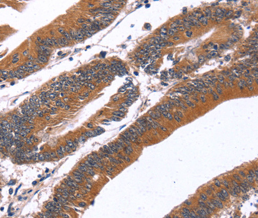 Immunohistochemistry of paraffin-embedded Human colon cancer tissue using GREB1 Polyclonal Antibody at dilution 1:40