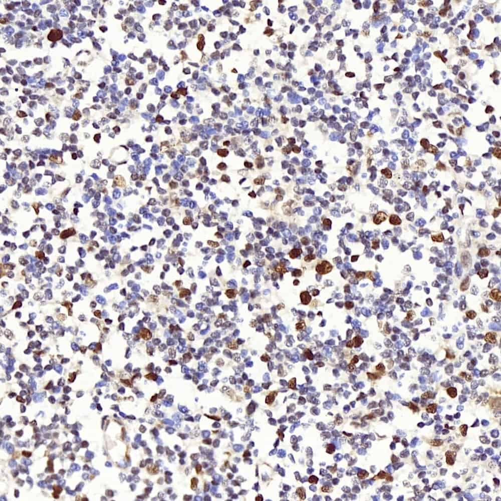 Immunohistochemistry analysis of paraffin-embedded Human tonsil  using Proliferating Cell Nuclear Antigen Polyclonal Antibody at dilution of 1:300.