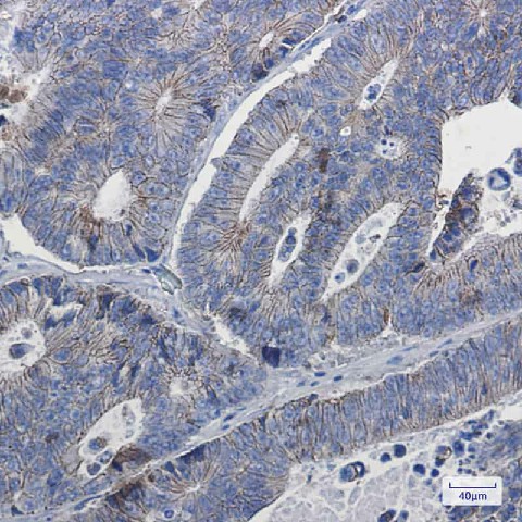 Immunohistochemistry of delta 1 Catenin in paraffin-embedded Human colon cancer tissue using delta 1 Catenin Rabbit mAb at dilution 1:50