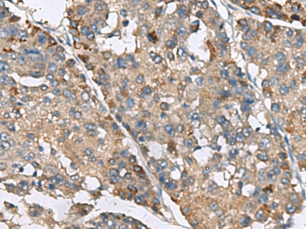 Immunohistochemistry of paraffin-embedded Human liver cancer tissue  using IP6K2 Polyclonal Antibody at dilution of 1:220(?200)