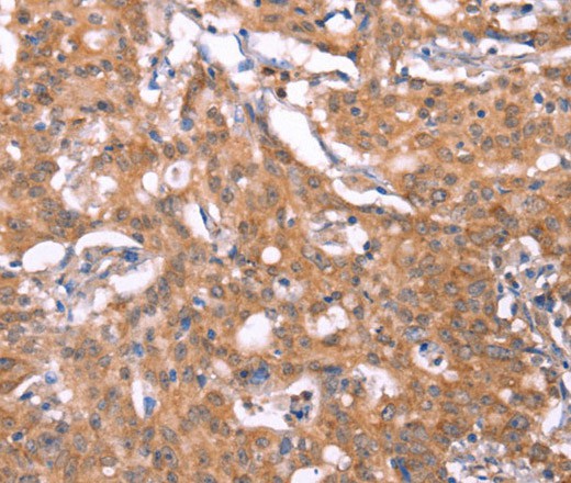 Immunohistochemistry of paraffin-embedded Human gasrtic cancer tissue using FBXO31 Polyclonal Antibody at dilution 1:40